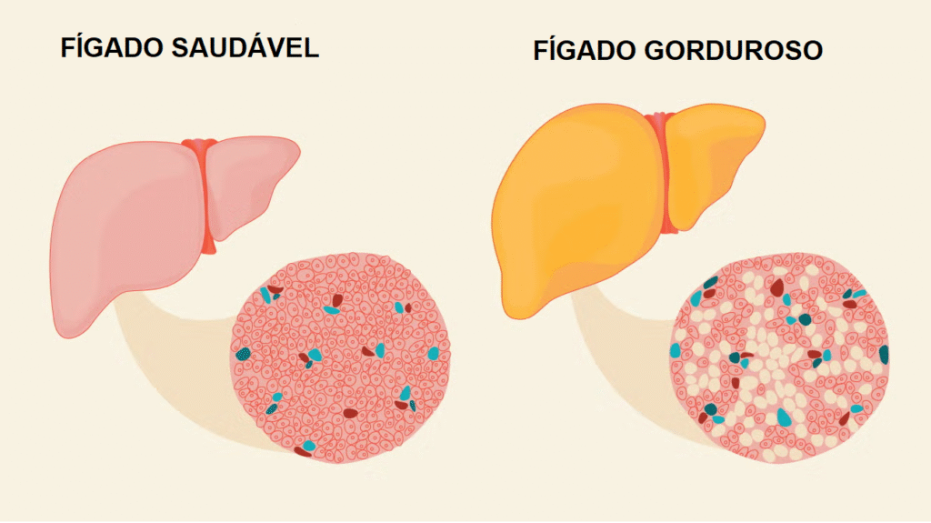 gordura no fígado aos 40 anos